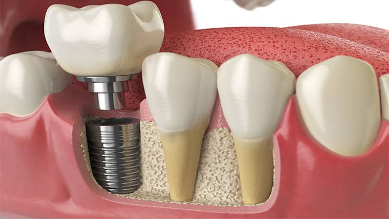 Implant dentaire en Tunisie : quel type de matériaux utilisés ?